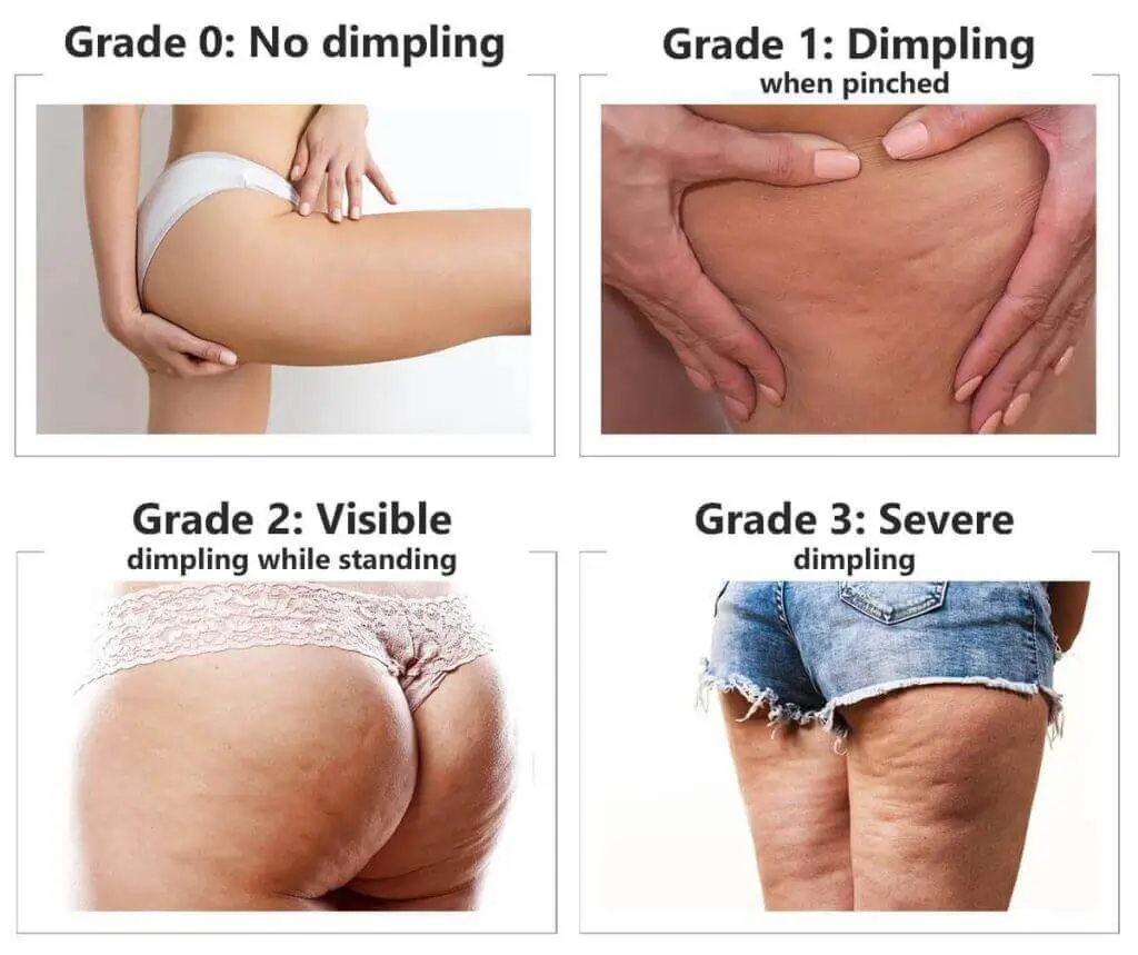 Representation of the stages of cellulite development Surrey