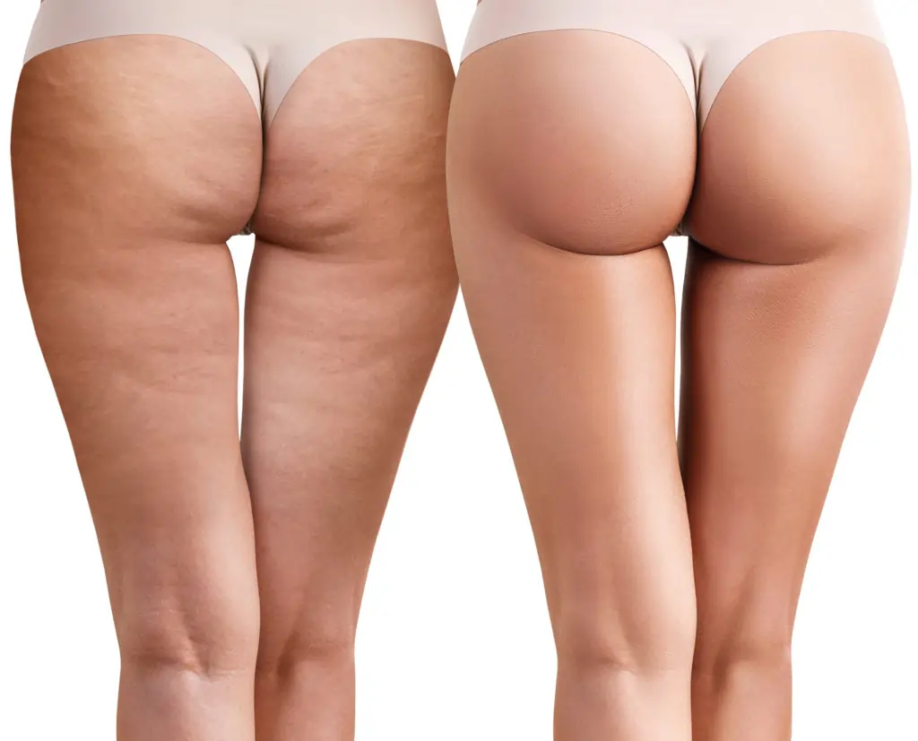 Read about cellulite Surrey: causes, treatments, and debunked myths